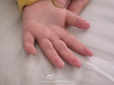 （　｀ハ´）「日本乳幼児の川崎病は中国からの菌類で起こった可能性があると言ってるアル…」 【中国の反応】
